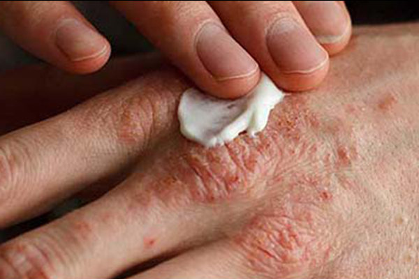 باکتری های خوب پوست سلاحی امیدبخش در مقابله با اگزما